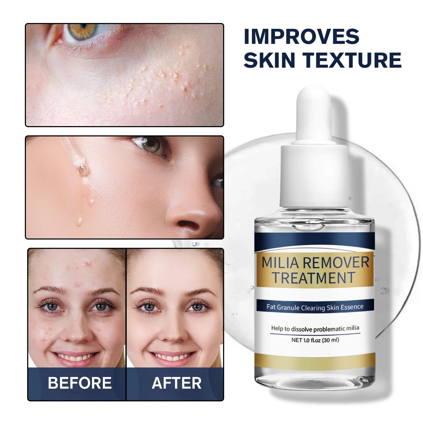 Hyaluronic Acid Serum - Эссенция для удаления милии, лечение жировых